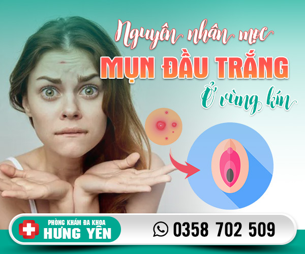 Nguyên nhân mọc mụn đầu trắng ở vùng kín