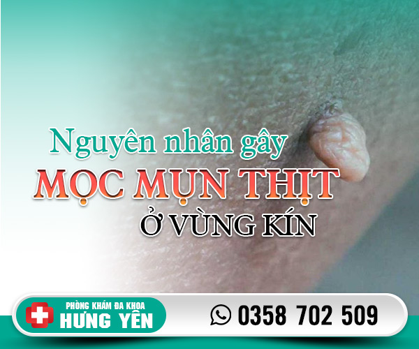 Nguyên nhân mọc mụn thịt ở vùng kín