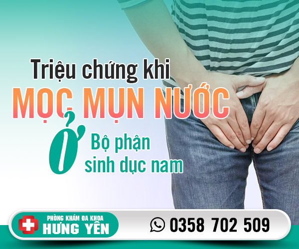 Triệu chứng khi mọc mụn nước ở bộ phận sinh dục nam