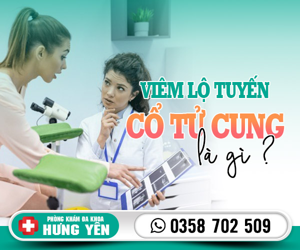 Viêm lộ tuyến cổ tử cung