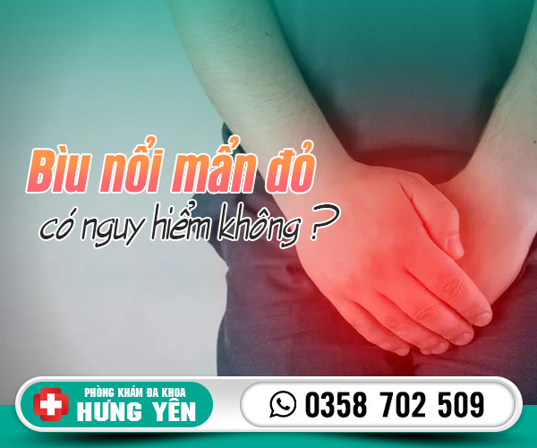 Biu nổi mẩn đỏ có nguy hiểm không