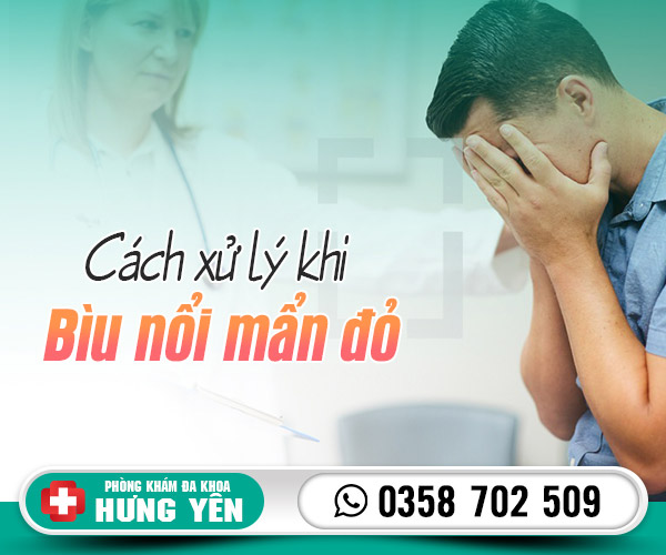 Cách xử lý khi bìu nổi mẩn đỏ