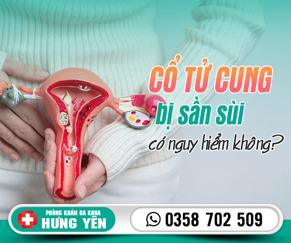 Cổ tử cung bị sần sùi có nguy hiểm không