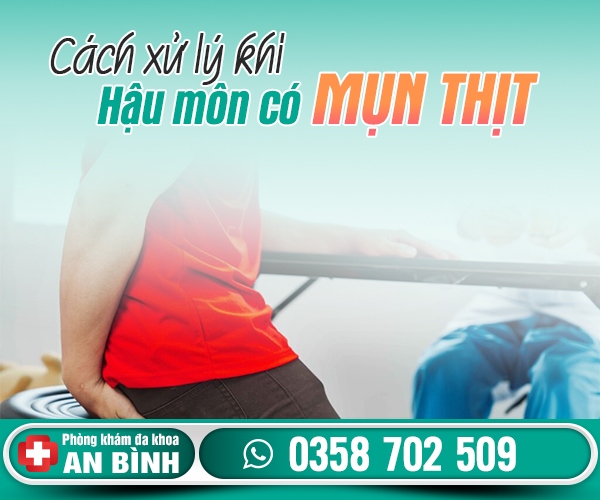 Cách xử lý khi hậu môn có mụn thịt