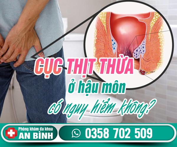 Cục thịt thừa ở hậu môn có nguy hiểm không
