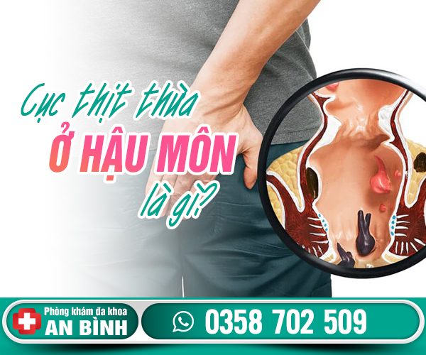 Cục thịt thừa ở hậu môn