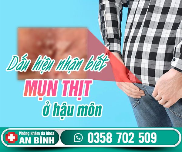 Dấu hiệu nhận biết mụn thịt ở hậu môn