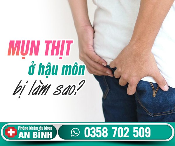 Mụn thịt ở hậu môn bị làm sao?