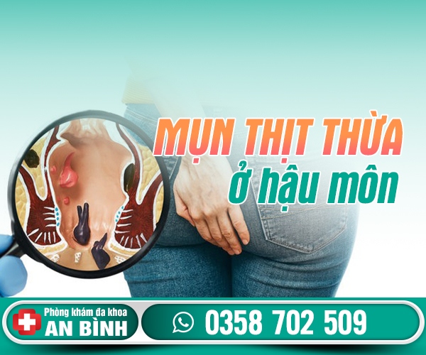 Mụn thịt thừa ở hậu môn