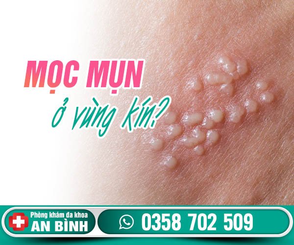 Mọc mụn ở vùng kín