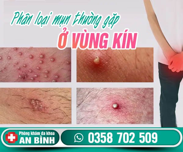 Phân loại mụn ở vùng kín thường gặp